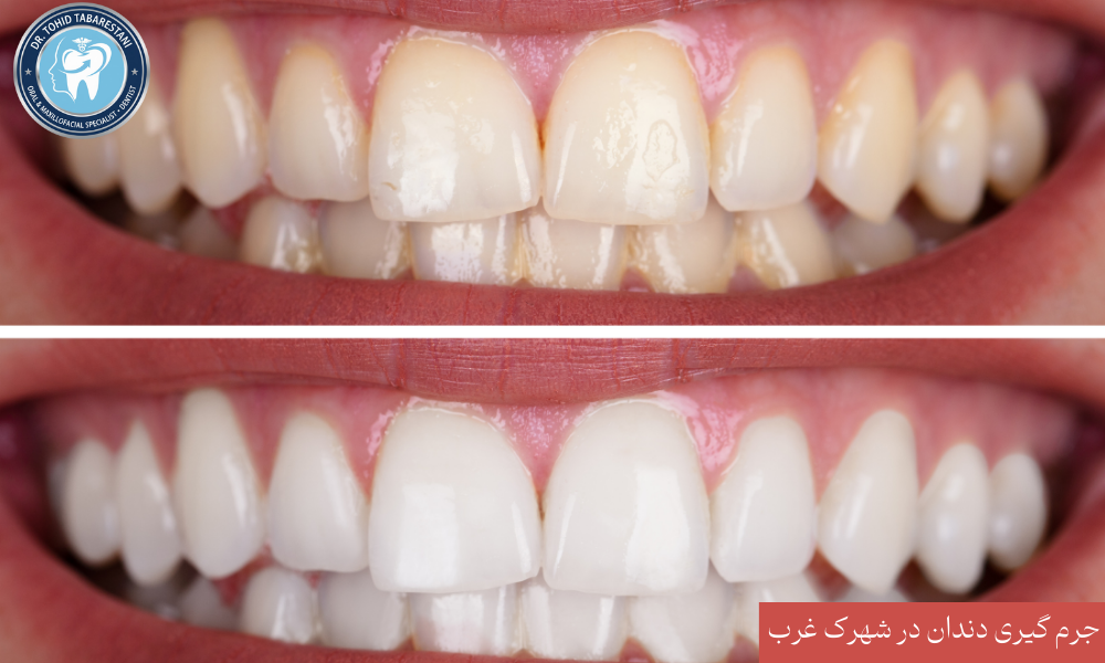 جرم گیری دندان چیست و چه مزایایی دارد