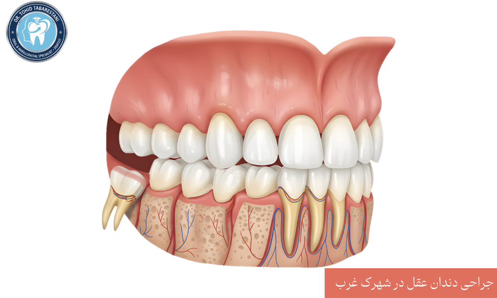 دندان عقل نهفته چیست و کجاست