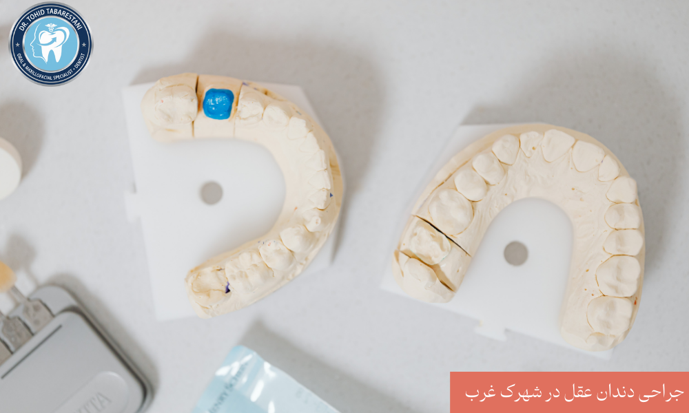 دلایل کشیدن یا جراحی دندان عقل نهفته