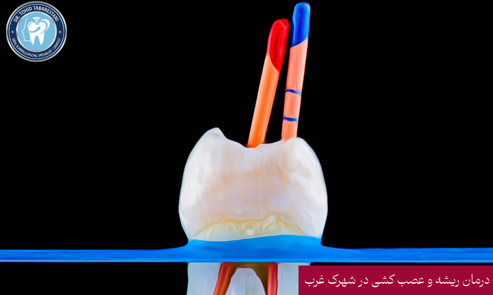 درمان ریشه دندان و عصب کشی با دستگاه روتاری در شهرک غرب