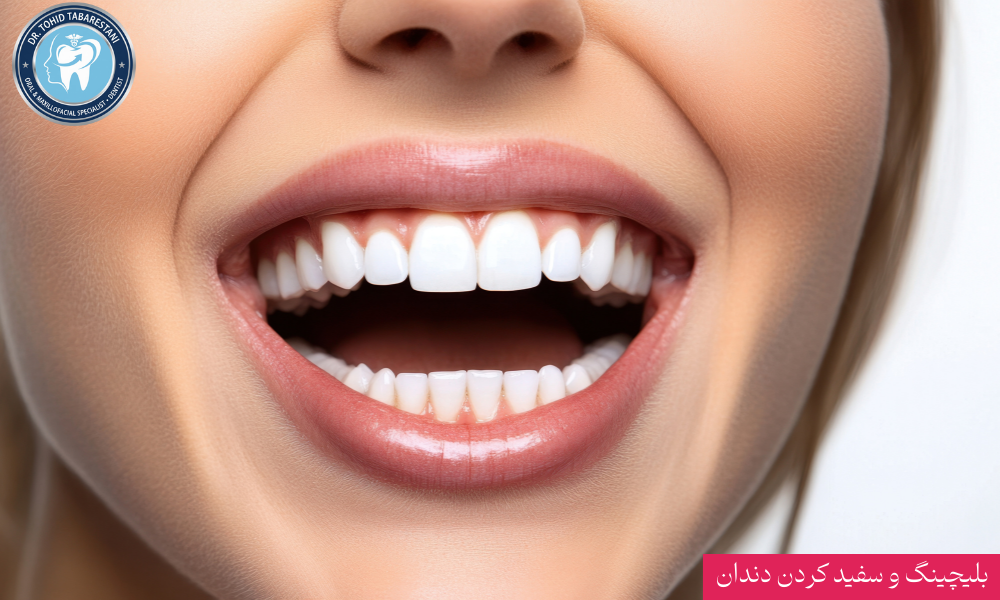 تفاوت دندان قبل و بعد از بلیچینگ و سفید کردن