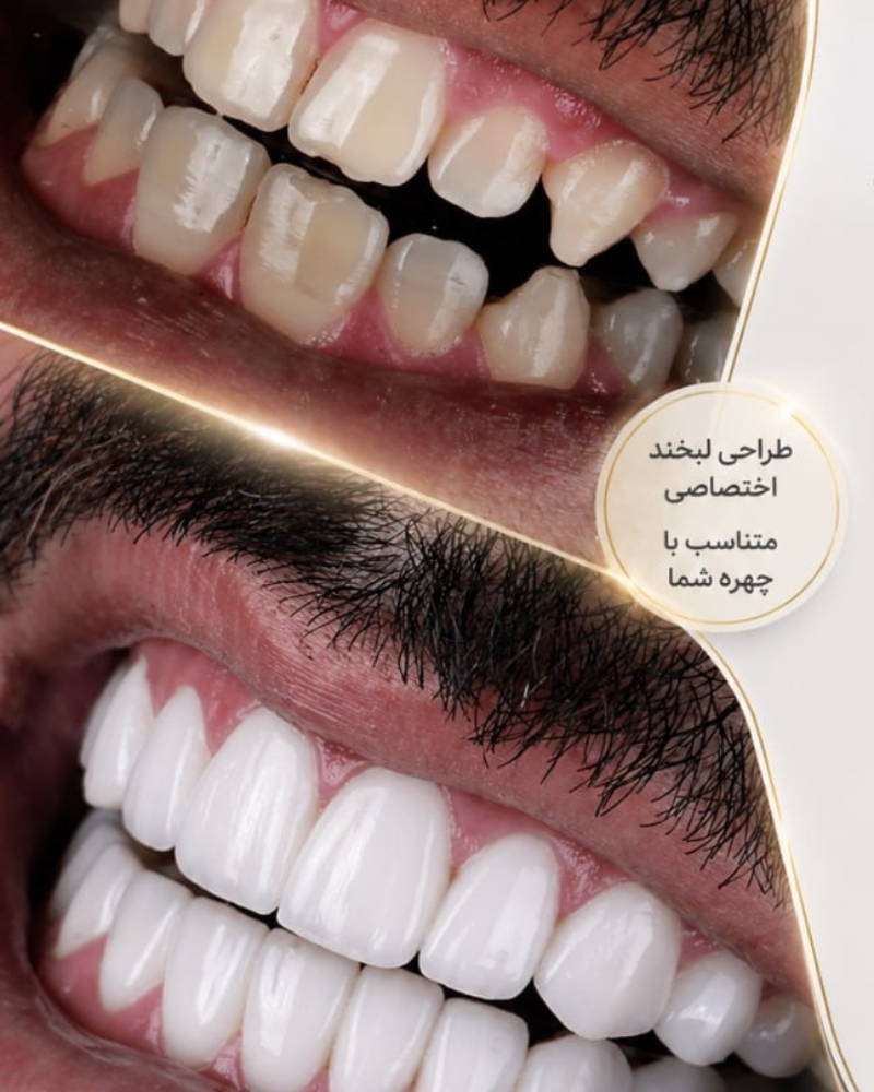 نمونه کار کامپوزیت 11